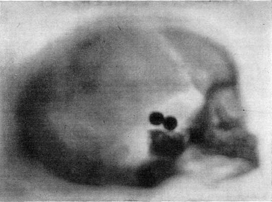 FIGURE 7.&mdash;SKIAGRAPH OF A BABY'S SKULL, SHOWING TWO BUCK-SHOT PLACED UNDER THE SKULL.