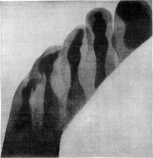 FIGURE 9.&mdash;SKIAGRAPH OF A HUMAN FOOT, SHOWING THE DEFORMITY IN THE LAST TWO TOES