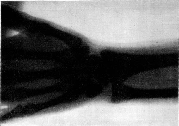 FIGURE 11.&mdash;SKIAGRAPH OF A HUMAN WRIST WHICH HAD BEEN DISLOCATED.