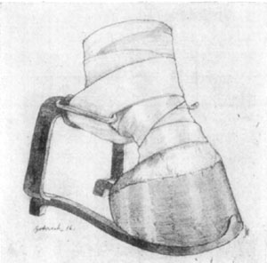 Fig. 28—Showing the Roberts brace in operation.
