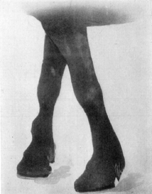 Fig. 29—Distension of theca of the extensor of the digit
(extensor pedis). Fig. 29—Distension of theca of the extensor of the digit
(extensor pedis).