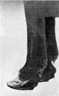 Fig. 33—The hoof in chronic laminitis. Note the
concavity. This animal was serviceable for any work that could be
performed at a walk.