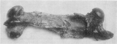 Fig. 47—Same bone as in Fig. 46 after about six months'
treatment. In this case Dr. Merillat employed a weight to counteract
muscular contraction. It is noticeable that very little provisional
callus has formed in this case, and in spite of unusual ingenuity and
good facilities for caring for the subject, union of bone did not
occur.