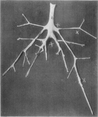 Fig. 48—Exposure of aorta and its branches, showing
location of thrombi in numerous places. In this case (same as Fig. 49)
Dr. L.A. and Dr. Edward Merillat found the cause of the condition to be
due to sclerastomiasis.