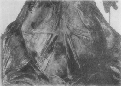 Fig. 49—Illustrative of thrombosis of the aorta,
iliacs and branches. Photo by Dr. L.A. Merillat.