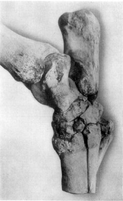 Fig. 53—Lateral (external) view of tarsus showing
effects of generalized tarsitis. Fig. 53—Lateral (external) view of tarsus showing
effects of generalized tarsitis.