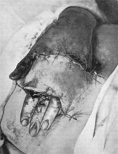 Fig. 1.&mdash;Ulcer of back of Hand covered by flap of skin raised from anterior abdominal wall. The lateral edges of the flap are divided after the graft has adhered.
