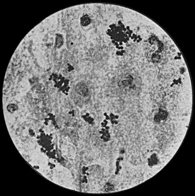 Fig. 2.&mdash;Staphylococcus aureus in Pus from case of Osteomyelitis. &times; 1000 diam. Gram's stain.
