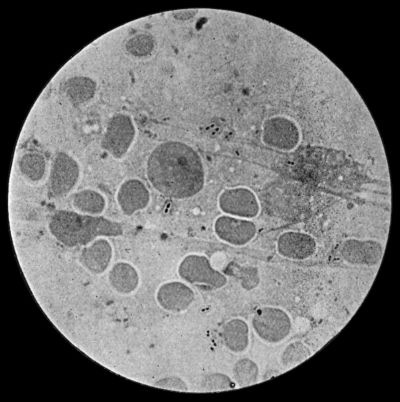 Fig. 5.&mdash;Fraenkel's Pneumococci in Pus from Empyema following Pneumonia. &times; 100 diam. Stained with Muir's capsule stain.