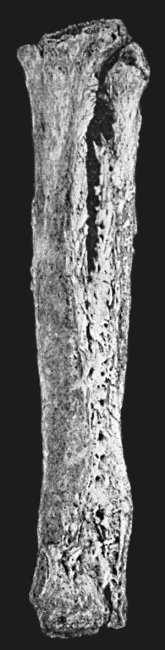 Fig. 19.&mdash;Tibia and Fibula, showing changes due to chronic ulcer of leg.