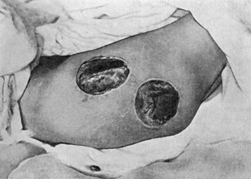 Fig. 24.&mdash;Acute Bed-Sores over Right Buttock.