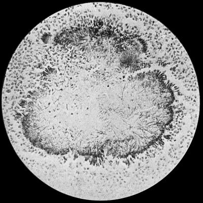 Fig. 30.&mdash;Section of Actinomycosis Colony in Pus from Abscess of Liver, showing filaments and clubs of streptothrix actinomyces. &times; 400 diam. Gram's stain.