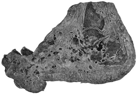 Fig. 32.&mdash;Mycetoma, or Madura Foot. (Museum of Royal College of Surgeons, Edinburgh.)