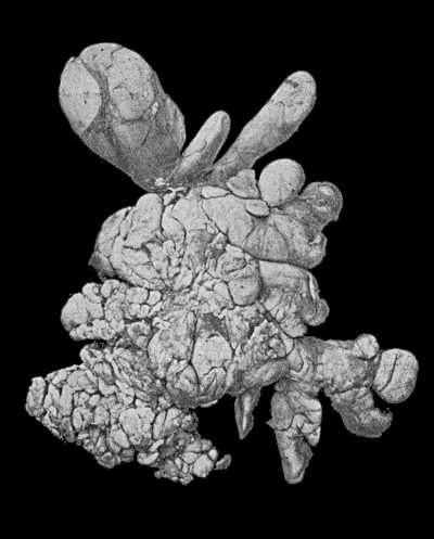 Fig. 45.&mdash;Subcutaneous Lipoma showing lobulation.