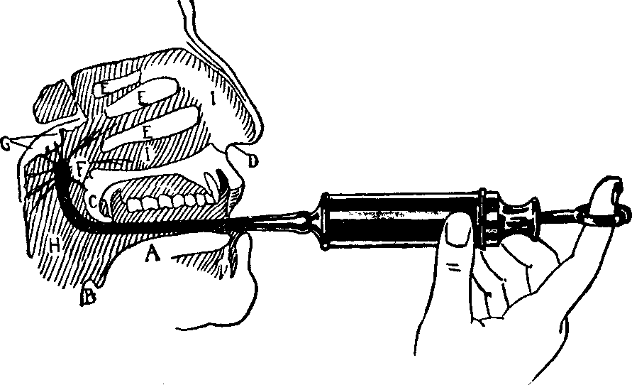 Illustration:
Fig. 16. Use of the Post-nasal Syringe in the treatment of Post-nasal
Catarrh.