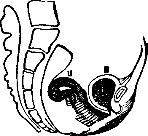 Illustration:
Fig. 10. Flexion, u, Uterus, B, Bladder.