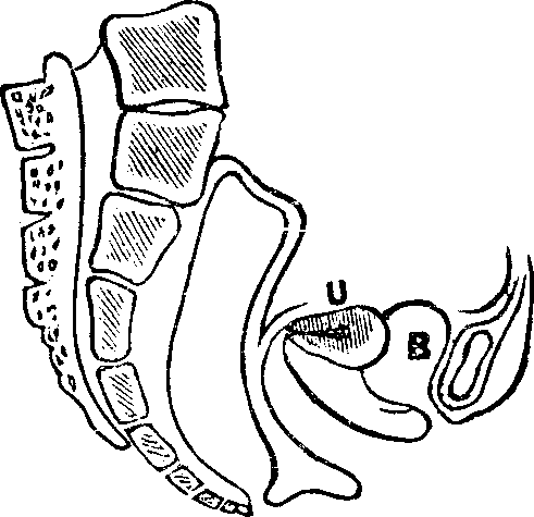 Illustration:
Fig. 11. Version, u, Uterus, B, Bladder.