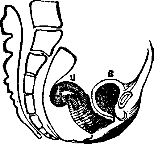 Illustration:
Fig. 12. Retroflexion, U, Uterus (Womb), B, Bladder.