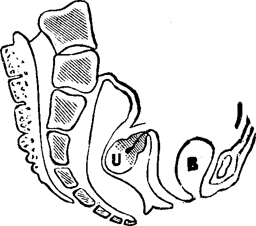 Illustration:
Fig. 13. Retroversion. B, Bladder. U, Uterus (Womb).