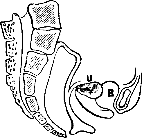 Illustration:
Fig. 14. Anteversion, U, Uterus, B, Bladder.