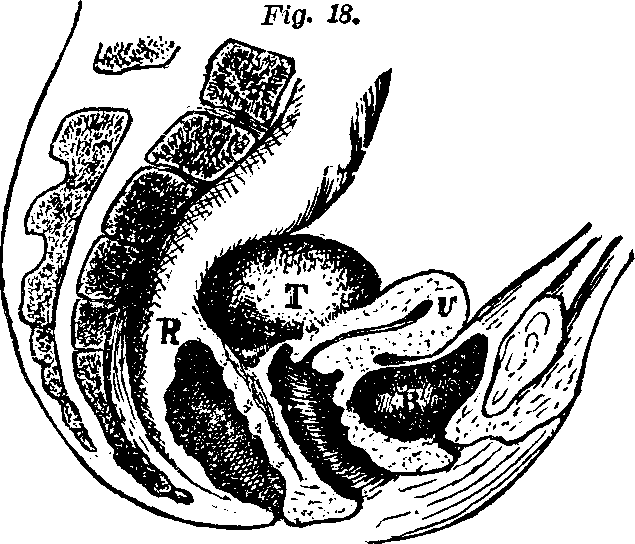 Illustration:
Fig. 18. U, Uterus. B, Bladder. R, Rectum. T, Tumor.