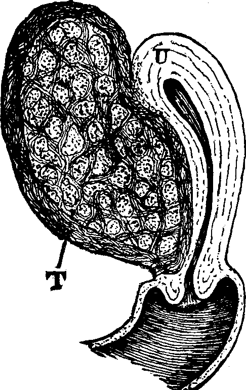 Illustration:
Fig. 20. U, Uterus. T, Tumor.