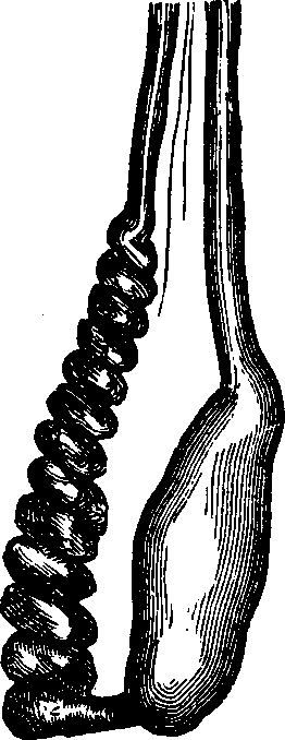 Illustration:
Fig. 2. Testicle wasted from Varicocele. The enlarged and torturous veins
are shown to be about as large as the testicle.