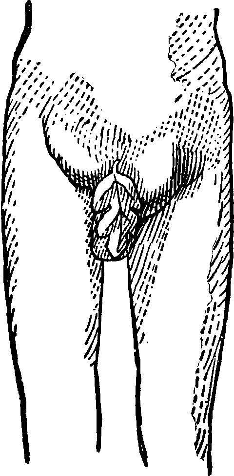 Illustration:
Fig. 1. Indirect Inguinal Hernia.