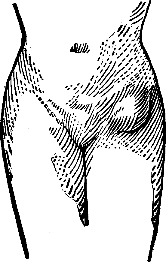 Illustration:
Fig. 2.  This figure illustrates a case of Femoral Hernia 