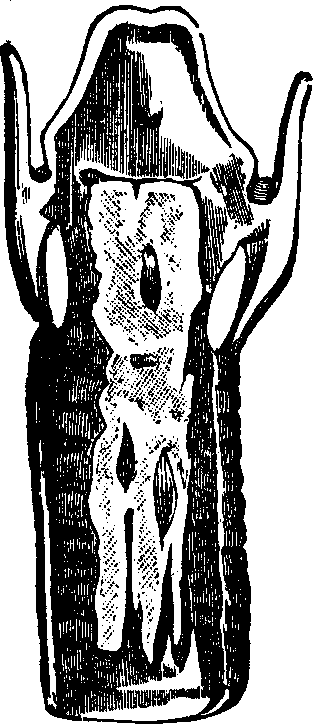 Illustration:
Fig. 1. False Membrane in Croup. From a specimen in Dr. Gross' cabinet.