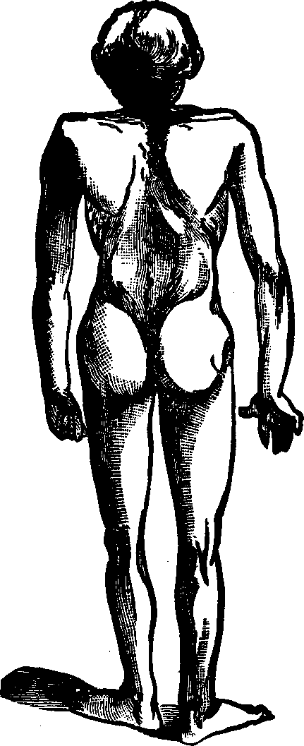 Illustration:
Fig. 4. Appearance of a child suffering from Pott's disease of the spine.