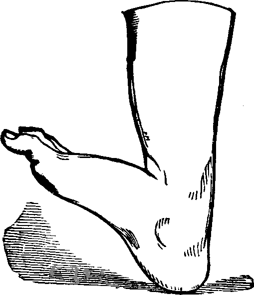 Illustration:
Fig. 11. Talipes Calcaneus.