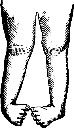 Illustration:
Fig. 13. Double Club-foot.