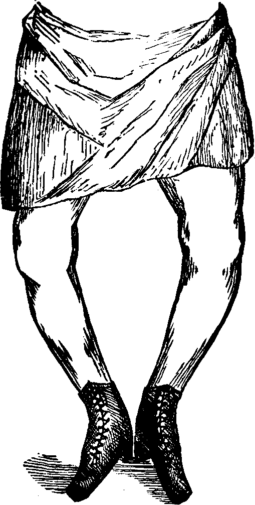 Illustration:
Fig. 14. Bow-legs.