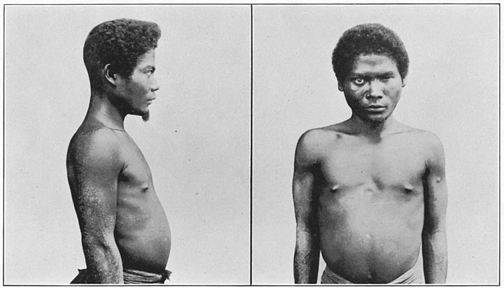 Negrito of Zambales, showing hair on the chin and skin disease on the arm.