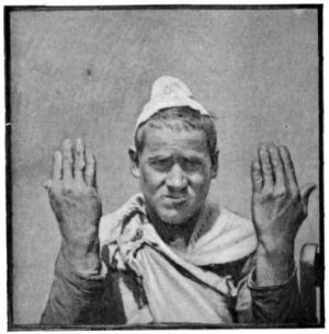 Mansing the Leper showing his Hands