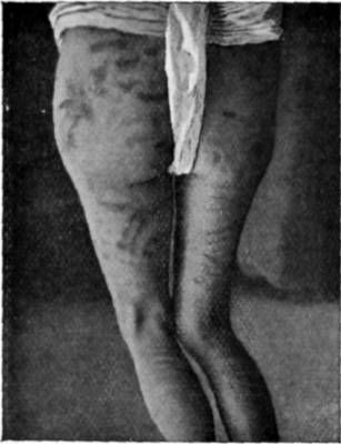 Chanden Sing's Legs, Showing Marks of Lashes and Wounds Healed