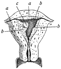 Fig. 11. Doorsnede van een baarmoeder, waarin een bevrucht ei zich vastgezet heeft. (Schroeder.)