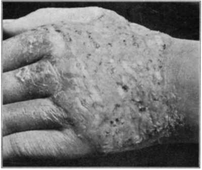 Blastomycetic dermatitis