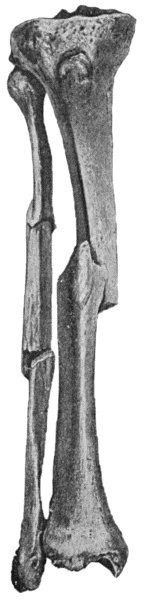 Fig. 1.—Multiple Fracture of both Bones of Leg.