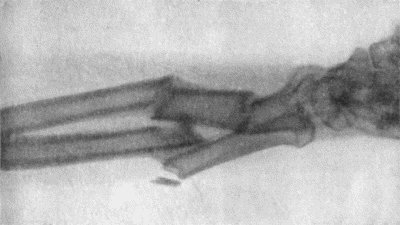 Fig. 2.—Radiogram of Comminuted Fracture of both Bones
of Forearm.