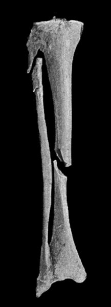 Fig. 3.—Showing (1) Oblique fracture of Tibia; (2)
Oblique fracture with partial separation of Epiphysis of upper end of
Fibula; (3) Incomplete fracture of Fibula in upper third. Result of
railway accident. Boy æt. 16.