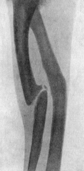 Fig. 6.—Radiogram of Un-united Fracture of Shaft of
Ulna of fifteen years' duration.