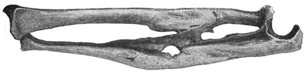 Fig. 7.—Excessive Callus Formation after infected
Compound Fracture of both Bones of Forearm—result of gun-shot wound.
Fusion of Bones across Interosseous Space.