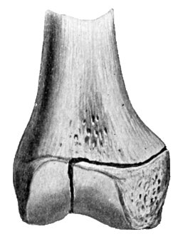 Fig. 10.—Partial Separation with Fracture of
Epiphysis.