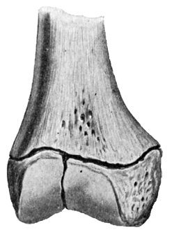 Fig. 11.—Complete Separation with Fracture of
Epiphysis.