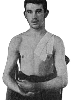 Fig. 15.—Adhesive Plaster applied for Fracture of
Clavicle.