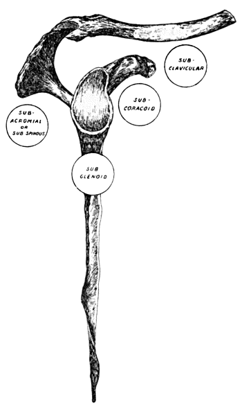 Fig. 17.—Diagram of most common varieties of
Dislocation of the Shoulder.