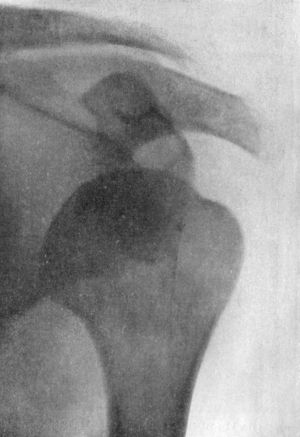 Fig. 19.—Sub-coracoid Dislocation of Humerus.