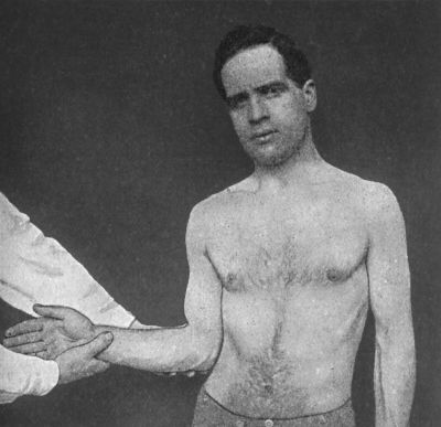 Fig. 20.—Kocher's Method of reducing Sub-coracoid
Dislocation—First Movement; Rotation of Arm away from Middle Line.